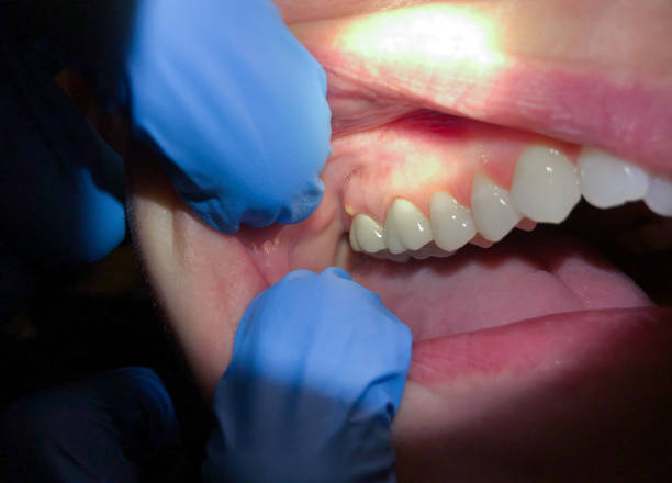 Best Emergency Wisdom Tooth Extraction in Arlington Heights, WA